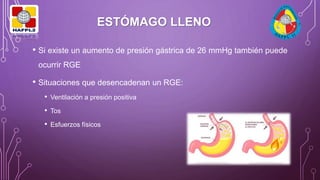 ESTÓMAGO LLENO
• Si existe un aumento de presión gástrica de 26 mmHg también puede
ocurrir RGE
• Situaciones que desencadenan un RGE:
• Ventilación a presión positiva
• Tos
• Esfuerzos físicos
 