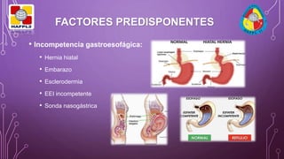 FACTORES PREDISPONENTES
• Incompetencia gastroesofágica:
• Hernia hiatal
• Embarazo
• Esclerodermia
• EEI incompetente
• Sonda nasogástrica
 