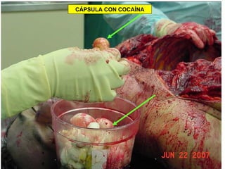 CÁPSULA CON COCAÍNA 