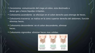 • Cecostomia: comunicación del ciego al colon, esta destinado a
denar gas y heces liquidas irritantes.
• Colostomía ascendente: se efectúan en el colon derecho para drenaje de heces.
• Colostomía trasversa: se realiza en la zona superior derecha del abdomen, función
eliminas heces.
• Colostomía descendente: en el colon descendente, eliminar
heces.
• Colostomía sigmoidea: eliminar heces mas solidas.
 