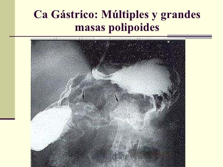 Frammenti Di Mucosa Gastrica Di Tipo Antrale E Fundico