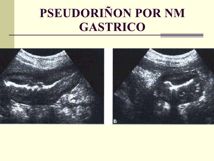 Frammenti Di Mucosa Gastrica Di Tipo Antrale E Fundico