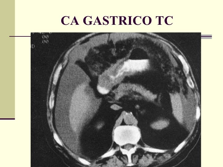Frammenti Di Mucosa Gastrica Di Tipo Antrale E Fundico