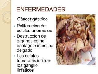 ENFERMEDADES
    Cáncer gástrico
•   Poliferacion de
    celulas anormales
•   Destruccion de
    organos como
    esofago e intestino
    delgado
•   Las celulas
    tumorales infiltran
    los ganglio
    linfaticos
 