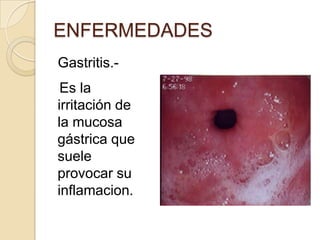 ENFERMEDADES
Gastritis.-
 Es la
irritación de
la mucosa
gástrica que
suele
provocar su
inflamacion.
 