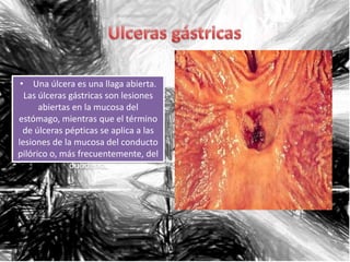• Una úlcera es una llaga abierta.
  Las úlceras gástricas son lesiones
      abiertas en la mucosa del
estómago, mientras que el término
  de úlceras pépticas se aplica a las
lesiones de la mucosa del conducto
pilórico o, más frecuentemente, del
              duodeno.
 