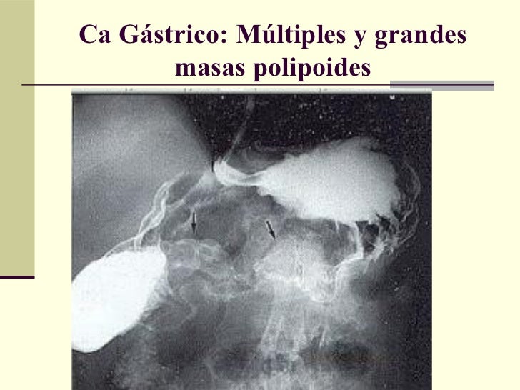 Frammenti Di Mucosa Gastrica Di Tipo Antrale E Fundico