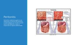 Peritonitis
Peritonitis o abdomen agudo es una
inflamación (irritación) del peritoneo,
el tejido delgado que recubre la pared
interna del abdomen y cubre la
mayoría de los órganos abdominales
 