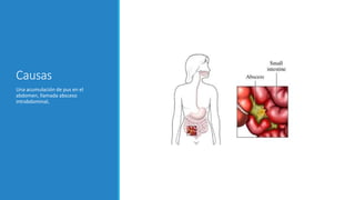 Causas
Una acumulación de pus en el
abdomen, llamada absceso
intrabdominal,
 