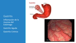 Gastritis
Inflamación de la
mucosa del
Estómago
Gastritis Aguda
Gastritis Crónica
 