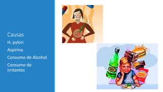 Causas
H. pylori
Aspirina
Consumo de Alcohol
Consumo de
irritantes
 