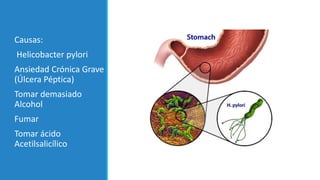 Causas:
Helicobacter pylori
Ansiedad Crónica Grave
(Úlcera Péptica)
Tomar demasiado
Alcohol
Fumar
Tomar ácido
Acetilsalicílico
 