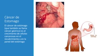 Cáncer de
Estomago
El cáncer de estómago
(que también se llama
cáncer gástrico) es el
crecimiento de células
cancerosas en el
recubrimiento y en la
pared del estómago
 