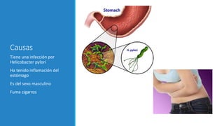 Causas
Tiene una infección por
Helicobacter pylori
Ha tenido inflamación del
estómago
Es del sexo masculino
Fuma cigarros
 