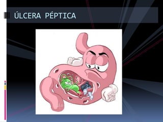 ÚLCERA PÉPTICA
 