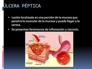 ÚLCERA PÉPTICA
 Lesión localizada en una porción de la mucosa que
penetra la muscular de la mucosa y puede llagar a la
serosa.
 Se presentan fenómenos de inflamación y necrosis.
 