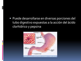  Puede desarrollarse en diversas porciones del
tubo digestivo expuestas a la acción del ácido
clorhídrico y pepsina
 
