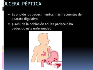 ÚLCERA PÉPTICA
 Es uno de los padecimientos más frecuentes del
aparato digestivo.
 5-10% de la población adulta padece o ha
padecido esta enfermedad.
 