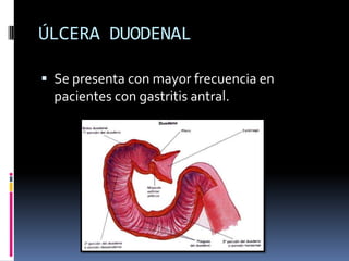 ÚLCERA DUODENAL
 Se presenta con mayor frecuencia en
pacientes con gastritis antral.
 