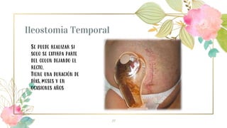 Ileostomia Temporal
11
Se puede realizar si
solo se extirpa parte
del colon dejando el
recto.
Tiene una duración de
días,meses y en
ocasiones años
 