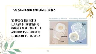 13
BOLSAS RECOLECTORAS DE HECES
Se coloca una bolsa
llamada dispositivo de
ostomía alrededor de la
abertura para permitir
el drenaje de las heces
 