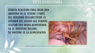 YEYUNOSTOMIA
14
Find more maps at slidescarnival.com/extra-free-resources-icons-and-maps
Cirugía realizada para crear una
abertura en el yeyuno (parte
del intestino delgado)desde el
exterior del cuerpo que permite
colocar una sonda alimentaria
en el intestino delgado.
Su objetivo es la alimentacion
 