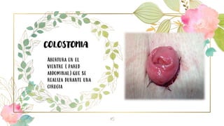 16
COLOSTOMIA
Abertura en el
vientre (pared
abdominal)que se
realiza durante una
cirugia
 