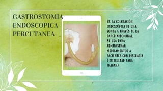 21
GASTROSTOMIA
ENDOSCOPICA
PERCUTANEA
.
Es la colocación
endoscópica de una
sonda a través de la
pared abdominal.
Se usa para
administrar
medicamentos a
pacientes con disflagia
(dificultad para
tragar)
 
