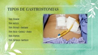 23
TIPOS DE GASTROSTOMIAS
Tipo Stamm
Tipo Witzel
Tipo Depage-Janeway
Tipo Beck-Carrel-Jianu
Tipo Patton
Tipo Spivack-Watsuji
 