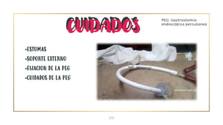24
CUIDADOS
•ESTOMAS
•SOPORTE EXTERNO
•FIJACION DE LA PEG
•CUIDADOS DE LA PEG
PEG: Gastrostomia
endoscópica percutanea
CUIDADOS
 