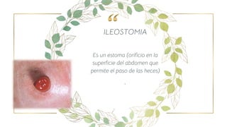 ILEOSTOMIA
Es un estoma (orificio en la
superficie del abdomen que
permite el paso de las heces)
.
7
 
