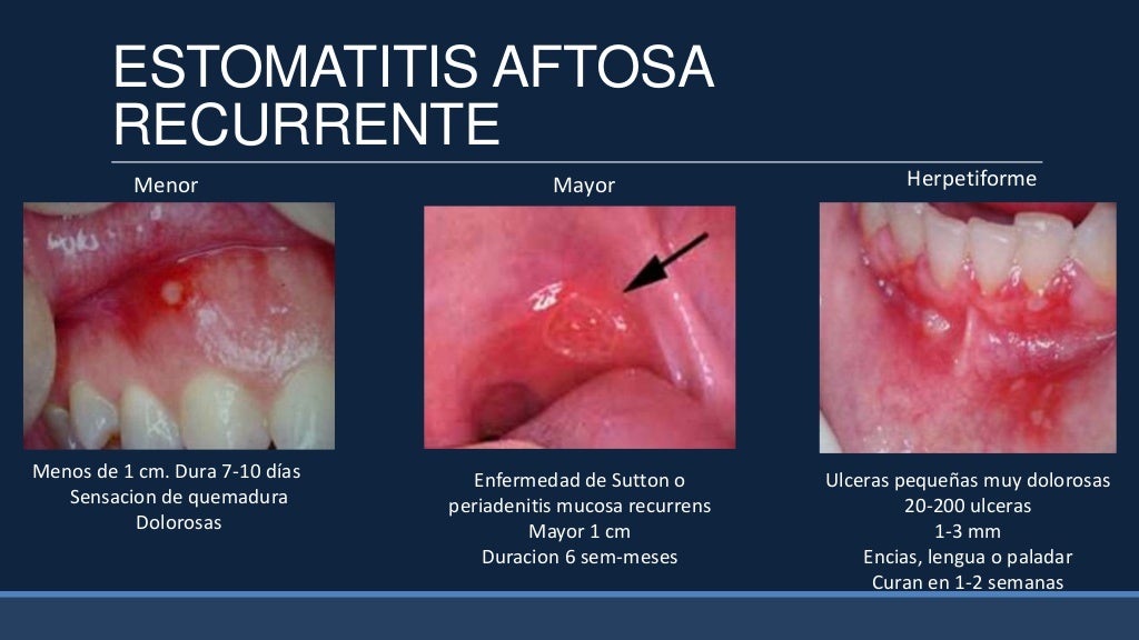Estomatitis