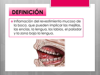 DEFINICIÓN
 Inflamación del revestimiento mucoso de
la boca, que pueden implicar las mejillas,
las encías, la lengua, los labios, el paladar
y la zona bajo la lengua.
 