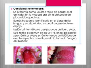  Candidiasis eritematosa:
- Se presenta como un área rojiza de bordes mal
definidos en la mucosa oral sin la presencia de
placas blanquecinas.
- Es más frecuente identificarla en el dorso de la
lengua y en el paladar, en una imagen doble en
espejo.
- Lesión asintomática o que produce un ligero picor.
- Esta forma es común en los VIH(+), en los pacientes
xerostómicos o que están tomando antibióticos de
amplio espectro, constituyendo la llamada "lengua
antibiótica".
 