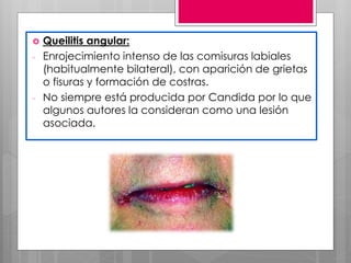  Queilitis angular:
- Enrojecimiento intenso de las comisuras labiales
(habitualmente bilateral), con aparición de grietas
o fisuras y formación de costras.
- No siempre está producida por Candida por lo que
algunos autores la consideran como una lesión
asociada.
 