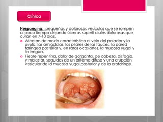 Herpangina: pequeñas y dolorosas vesículas que se rompen
al poco tiempo dejando úlceras superfi ciales dolorosas que
curan en 7-10 días.
 Afectan de modo característico al velo del paladar y la
úvula, las amigdalas, los pilares de las fauces, la pared
faríngea posterior y, en raras ocasiones, la mucosa yugal y
la lengua.
 Fiebre repentina, dolor de garganta, de cabeza, disfagia,
y malestar, seguidos de un eritema difuso y una erupción
vesicular de la mucosa yugal posterior y de la orofaringe.
Clínica
 