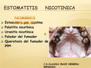 ESTOMATITIS    NICOTINICA NOMBRES PROBABLES: Estomatitis por nicotina Palatitis nicotínica Uranitis nicotínica Paladar del fumador Queratosis del fumador de pipa  C.D.CLAUDIA IRAIZ HERRERA MENDOZA 