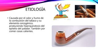 ETIOLOGÍA
• Causada por el calor y humo de
la combustión del tabaco y su
elemento oncogénico,
produciendo hiperqueratosis del
epitelio del paladar. También por
comer cosas calientes.
 
