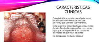 CARACTERISTICAS
CLINICAS
Cuando inicia se produce en el paladar un
eritema (enrojecimiento de mucosa
palatina), que luego se vuelve blanca.
En la superficie presenta elevaciones a modo
de pápulas circulares pequeñas con centros
rojos que corresponden a los conductos
excretores de glándulas palatinas.
No desaparece mediante presión.
 