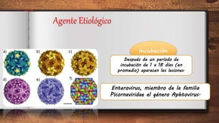 Agente Etiológico
Incubación
Enterovirus, miembro de la familia
Picornaviridae el género Aphtovirus.
Después de un período de
incubación de 1 a 18 días (en
promedio) aparecen las lesiones.
 