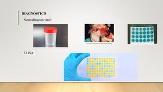 DIAGNÓSTICO
Neutralización viral:
ELISA: