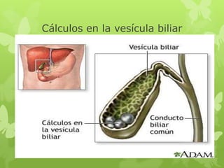 Cálculos en la vesícula biliar
 
