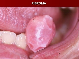 FIBROMA
FIBROMA
 