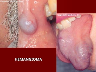 HEMANGIOMA
HEMANGIOMA
 