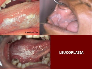 LEUCOPLASIA
LEUCOPLASIA
 