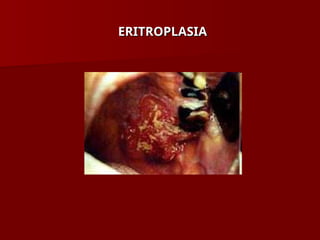 ERITROPLASIA
ERITROPLASIA
 