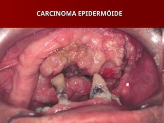 CARCINOMA EPIDERMÓIDE
CARCINOMA EPIDERMÓIDE
 