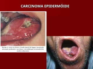CARCINOMA EPIDERMÓIDE
CARCINOMA EPIDERMÓIDE
 