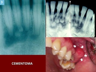 CEMENTOMA
CEMENTOMA
 