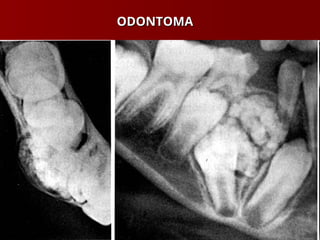 ODONTOMA
ODONTOMA
 